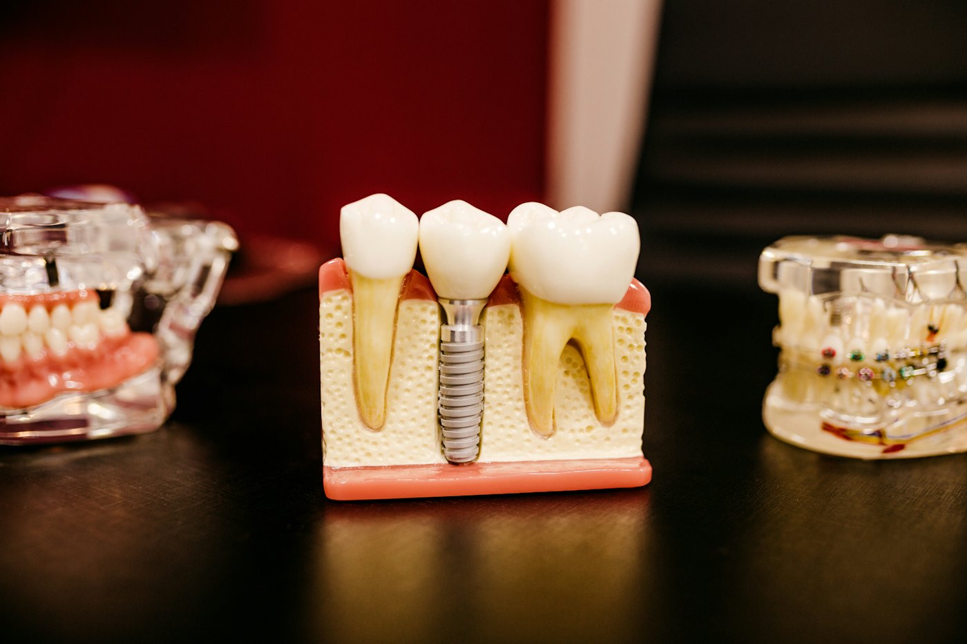 Implants & crowns